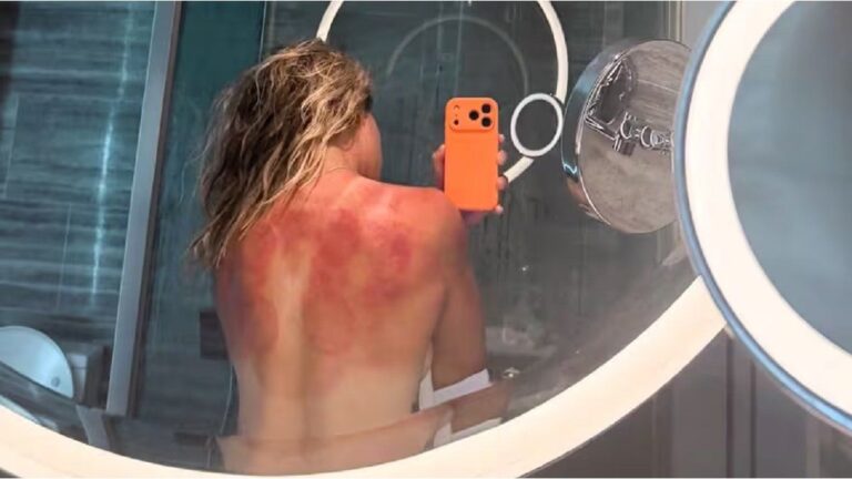 Una tenista encendió las alarmas en el Abierto de Australia por las quemaduras del sol en su espalda