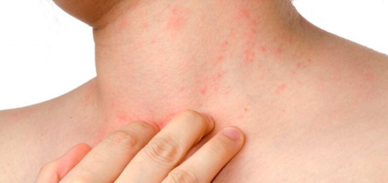Persona con dermatitis atópica en el brazo durante consulta médica